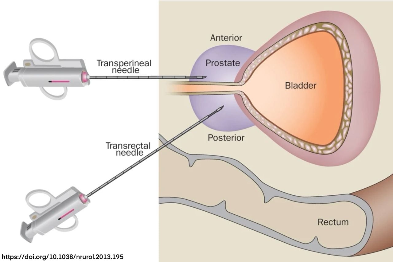 Prostate biopsy