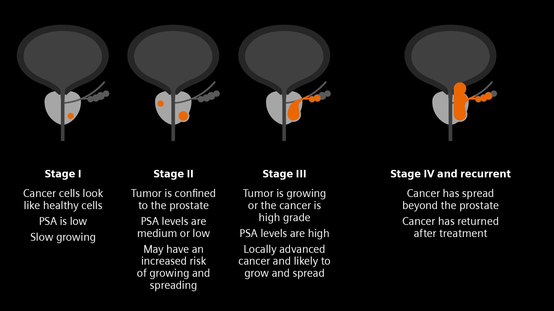 Stages of Prostate Cancer